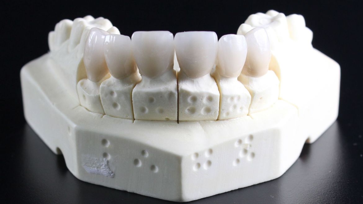 Jak dbać o implant zęba?